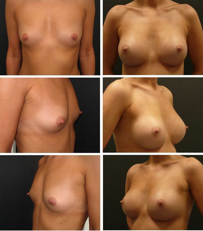 Powiększanie piersi - implanty anatomiczne Mentor CPG 323 345cc