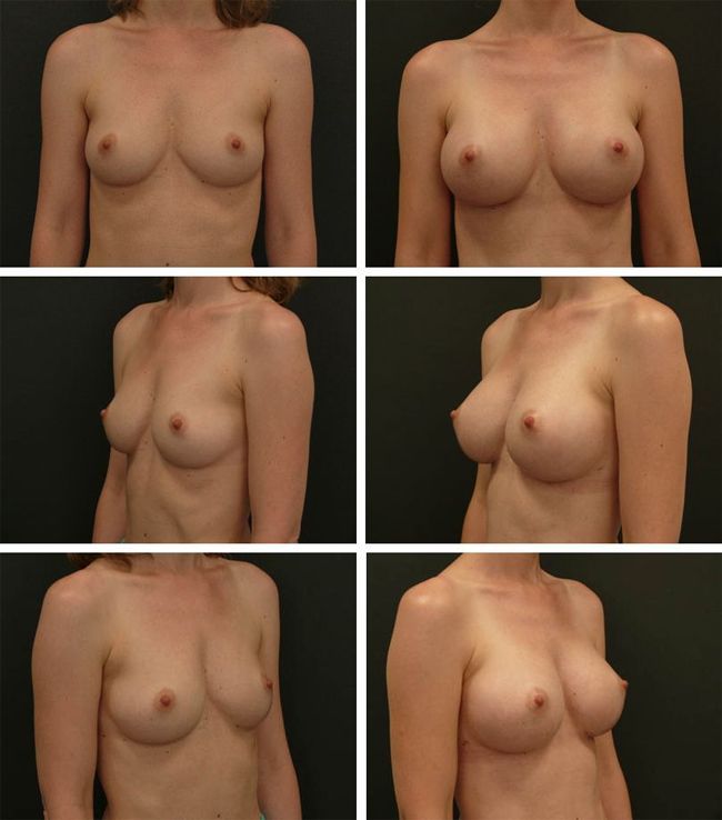 Powiększanie piersi - implanty anatomiczne Mentor CPG 321 245cc