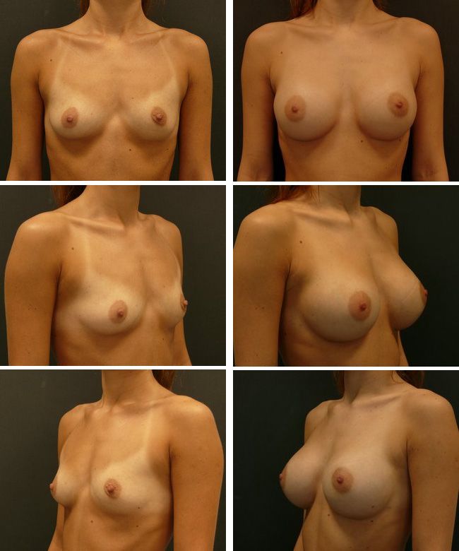 Powiększanie piersi - implanty anatomiczne Mentor CPG 322 330cc