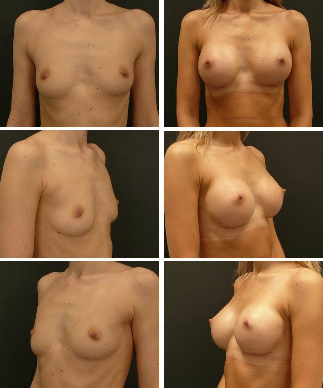 Powiększanie piersi - implanty anatomiczne Mentor  CPG 322 255cc