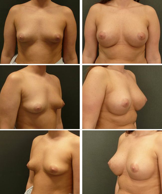 Powiększanie piersi - implanty anatomiczne Mentor CPG 322 295cc