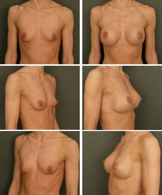 Powiększanie piersi - implanty anatomiczne Mentor CPG 322 295cc