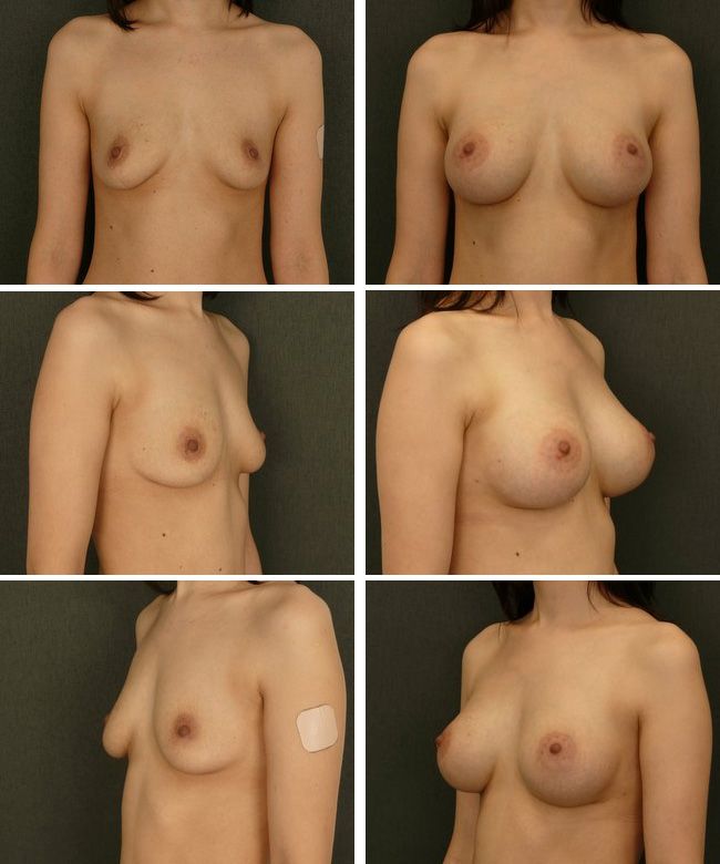 Powiększanie piersi - implanty anatomiczne Mentor CPG 333 390cc