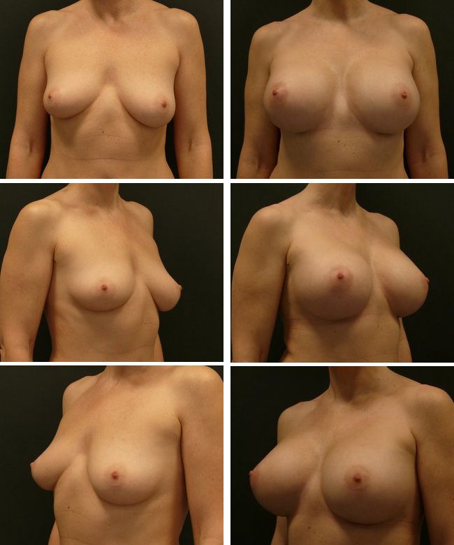 Powiększanie piersi - implanty anatomiczne Mentor CPG332 615cc