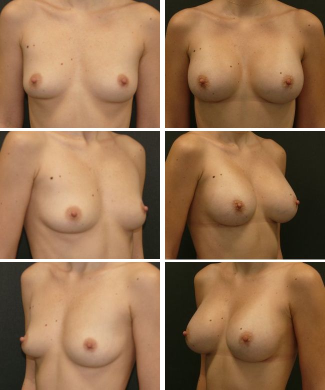 Powiększanie piersi - implanty anatomiczne Mentor CPG 332 305cc