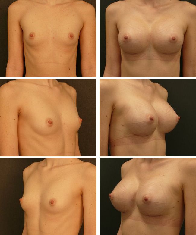 Powiększanie piersi - implanty anatomiczne Mentor CPG 332 395cc