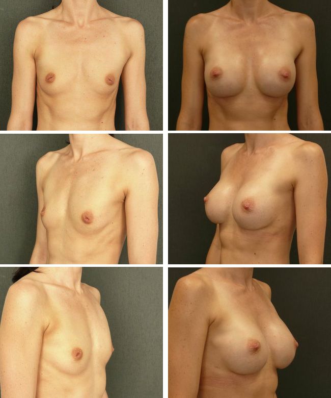 Powiększanie piersi - implanty anatomiczne Mentor CPG 332 270cc