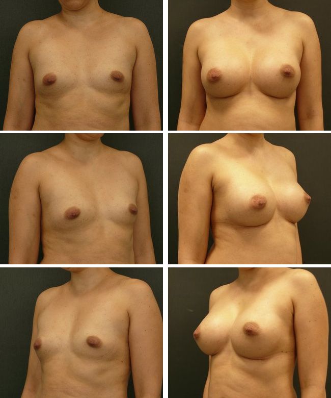 Powiększanie piersi - implanty anatomiczne Mentor CPG 322 330cc