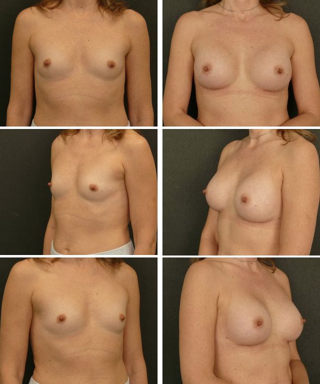Powiększanie piersi - implanty anatomiczne Mentor CPG 332 255cc