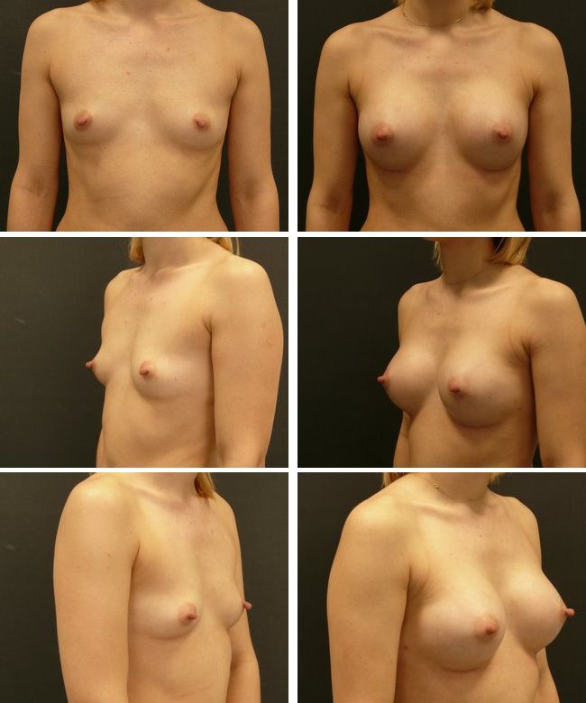Powiększanie piersi - implanty anatomiczne Mentor CPG 323 225cc