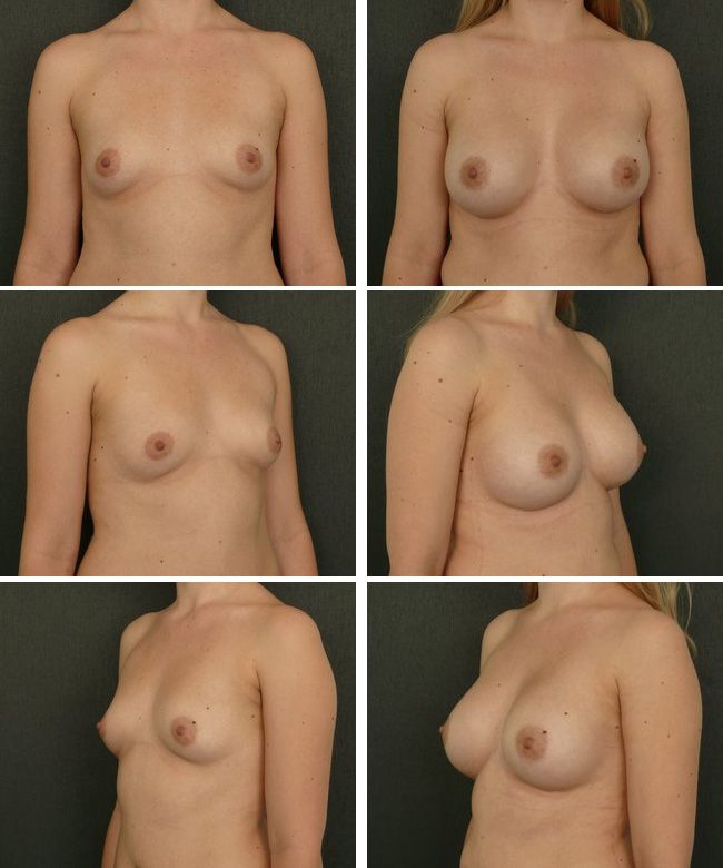 Powiększanie piersi - implanty anatomiczne Mentor CPG 332 350cc