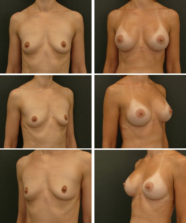Powiększanie piersi - implanty anatomiczne Mentor CPG 332 350cc