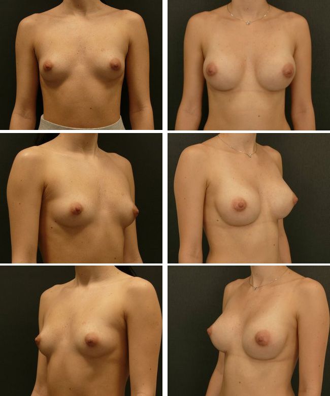 Powiększanie piersi - implanty anatomiczne Mentor CPG 322 255cc