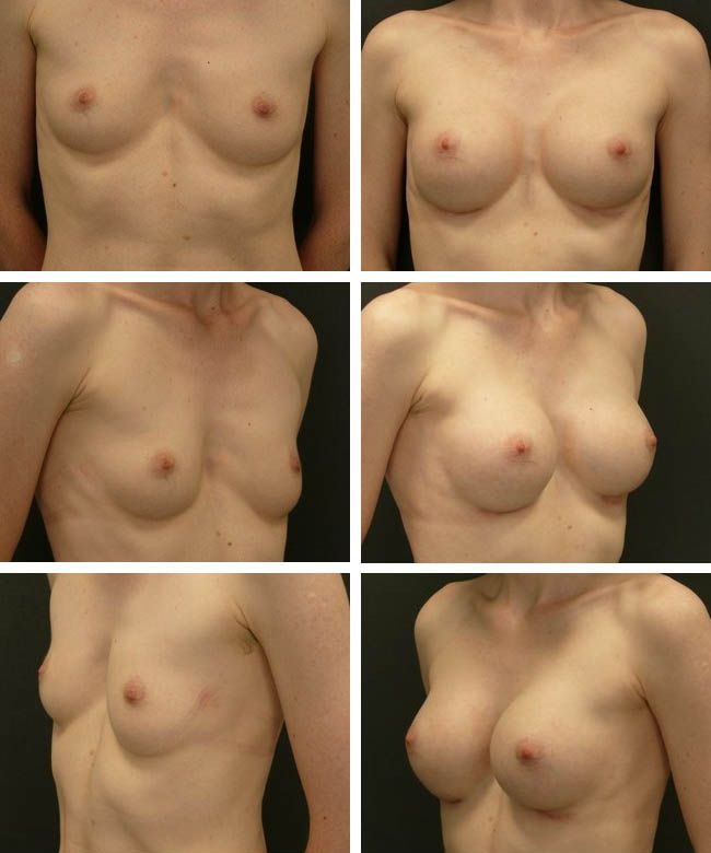 Powiększanie piersi - Asymetria piersi Pierś prawa: Mentor CPG 322 255cc, pierś lewa: Mentor CPG 322 225cc.