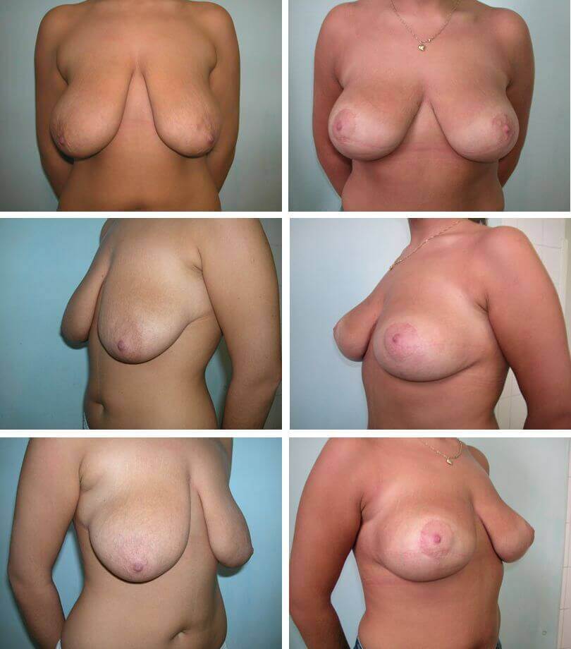 2. Korekcja kształtu piersi (mastopeksja)