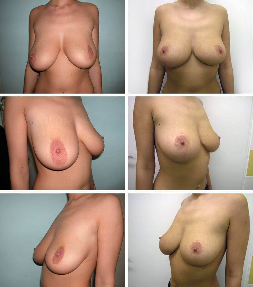 3. Mastopeksja - Korekcja kształtu piersi