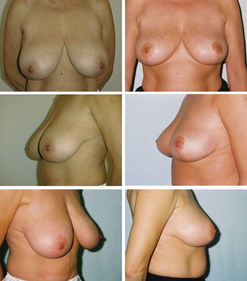 Mastopeksja - Korekcja kształtu piersi