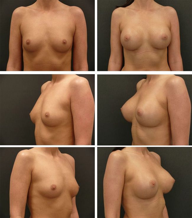 Powiększanie piersi - implanty okrągłe 