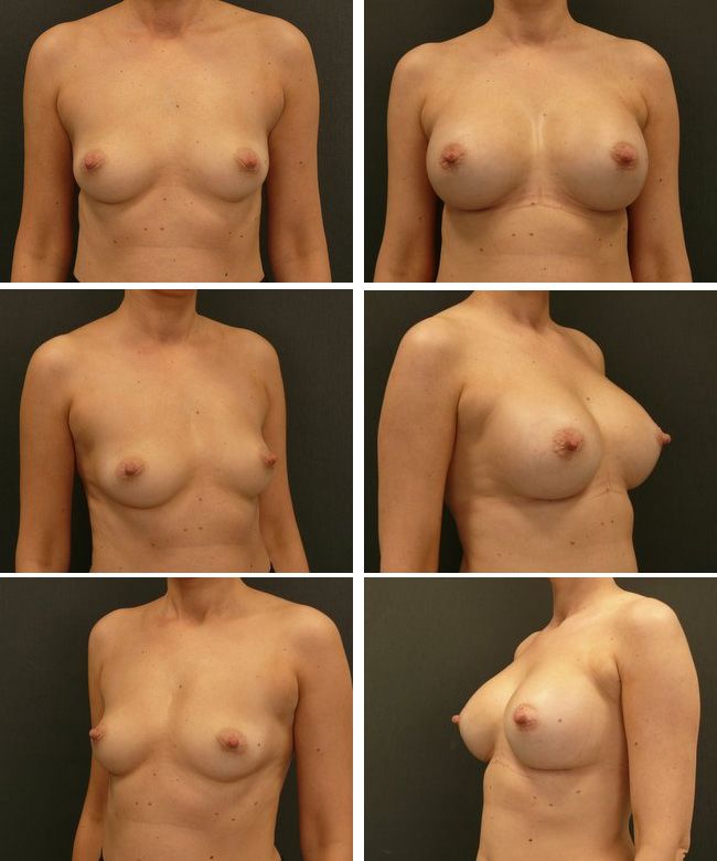 Powiększanie piersi - implanty okrągłe 