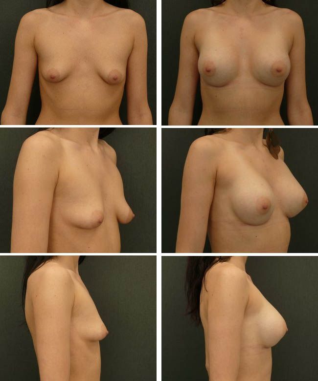 Powiększanie piersi - tuberous breast Mentor CPG332 305cc