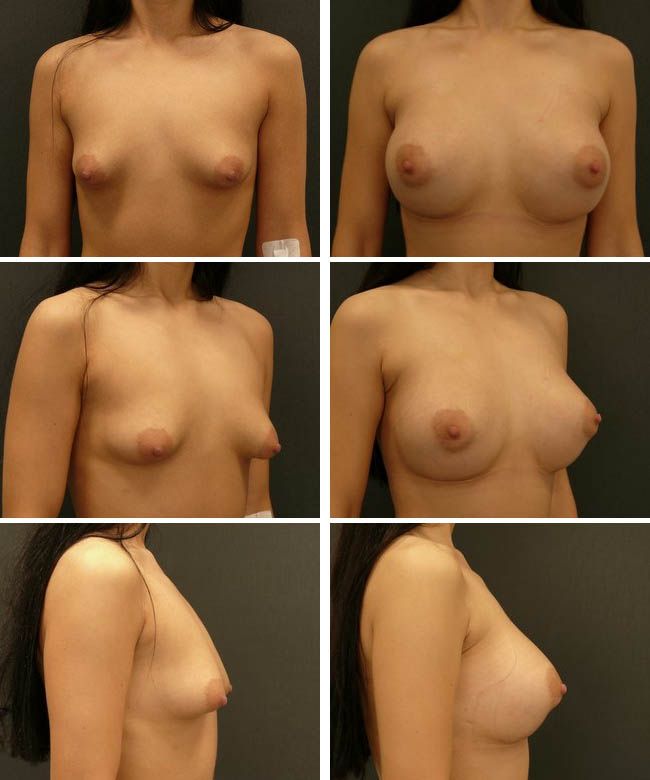 Powiększanie piersi - tuberous breast Mentor HP 350cc