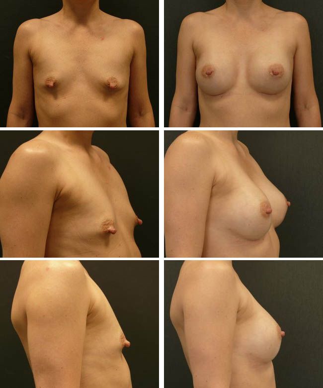 Powiększanie piersi - tuberous breast Mentor CPG322 295cc