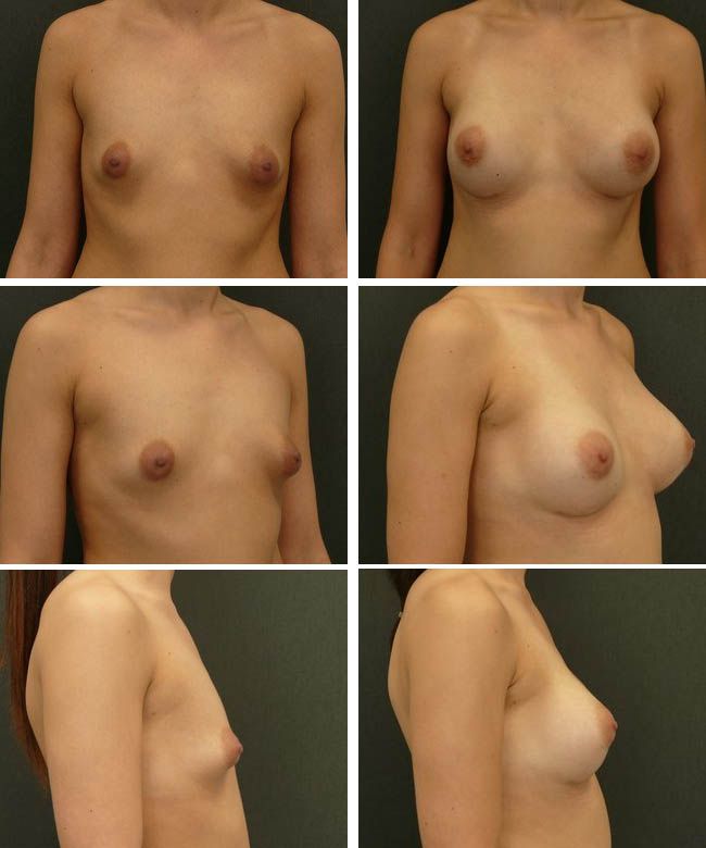 Powiększanie piersi - tuberous breast Mentor HP 300cc