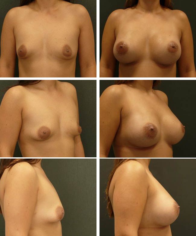 Powiększanie piersi - tuberous breast Mentor CPG323 345cc