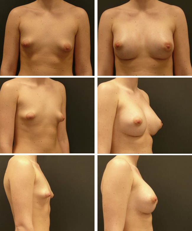 Powiększanie piersi - tuberous breast Mentor CPG332 305cc