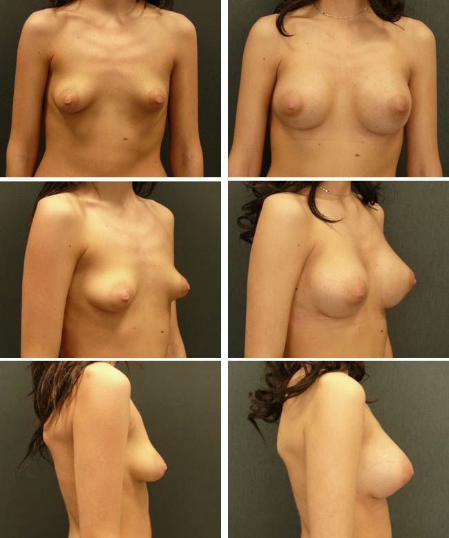 Powiększanie piersi - tuberous breast Pierś prawa: Mentor CPG332 270cc, pierś lewa: Mentor CPG332 305cc.